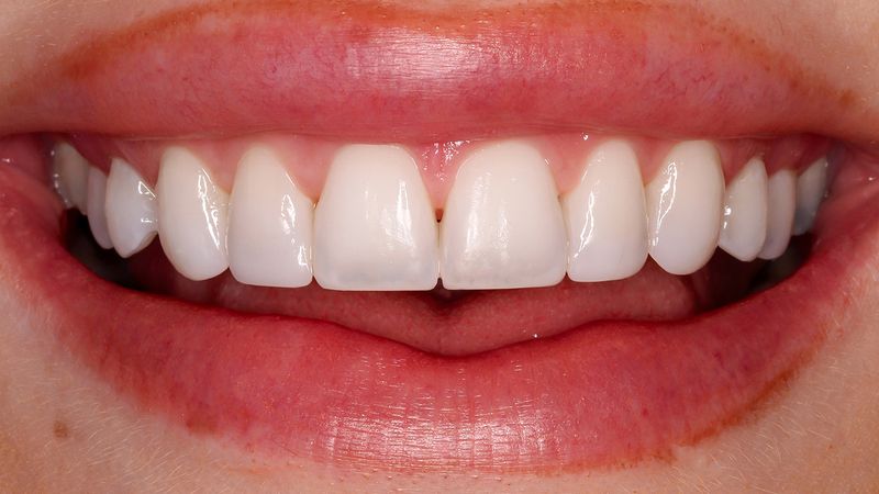 Composite Versus Edge Bonding